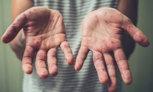 Lee más sobre el artículo Van 10 casos de sarampión en Querétaro